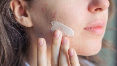 Close up of a woman applying acne treatment to her skin, representing benzoyl peroxide class actions.