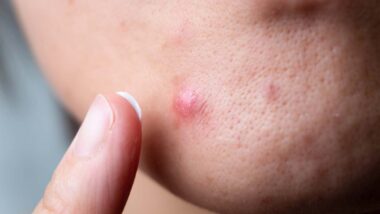 Close up of woman putting acne spot treatment cream on a pimple, representing the Johnson & Johnson class action.
