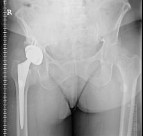 metal on metal hip implant class action lawsuit settlement