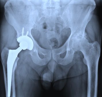 Stryker metal hip implant