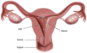intrauterine (IUD) birth control