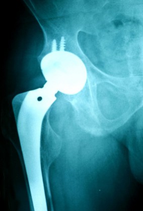 Metal Hip Implant Lawsuit