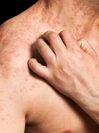 Lamictal skin rash