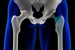 Metal Hip Implant Lawsuit