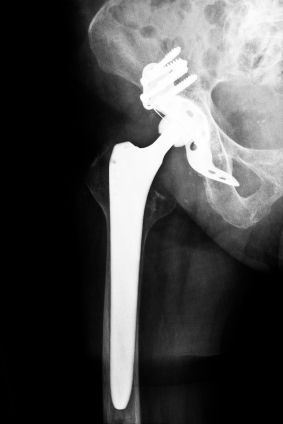 iStock-Artificial-Hip-Implant