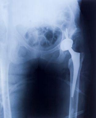 artificial hip implant