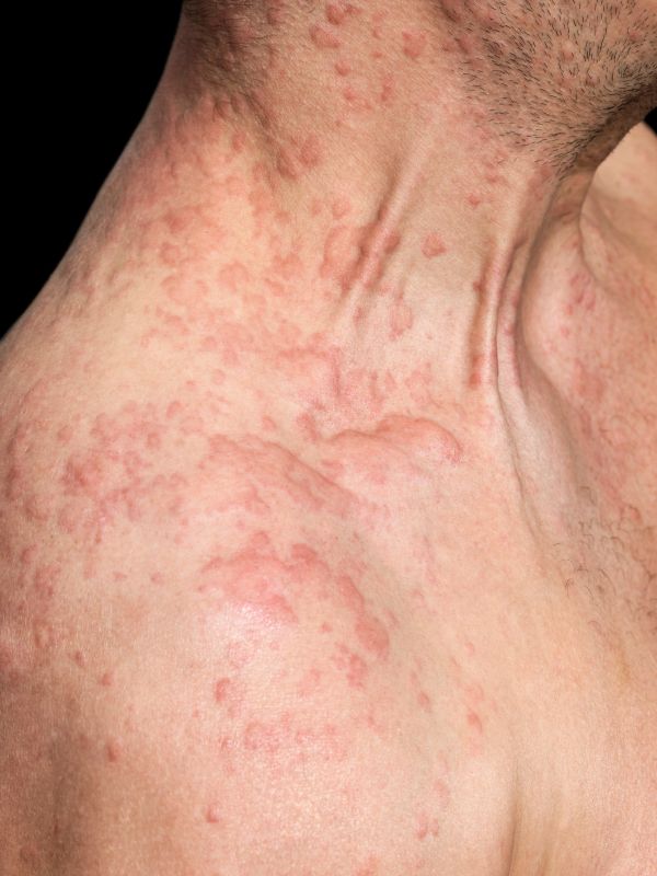 Antibiotic Levaquin May Cause Severe SJS Skin Rash - Top Class Actions
