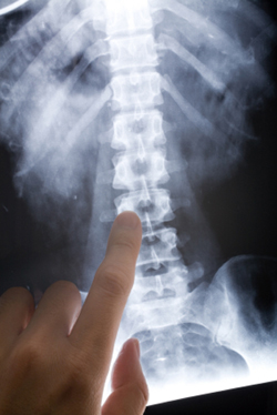 infuse bone graft spinal surgery