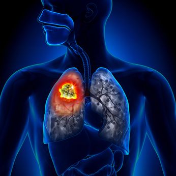 asbestos lung cancer