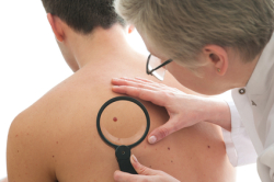 viagra melanoma skin cancer