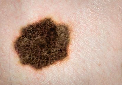 melanoma skin cancer mole