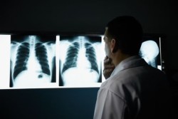 asbestos-lung-cancer