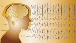 epilepsy-brain-waves