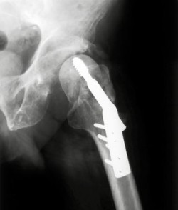 hip-implant-xray