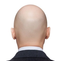 propecia-bald-head