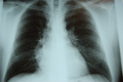 asbestos-disease-lungs