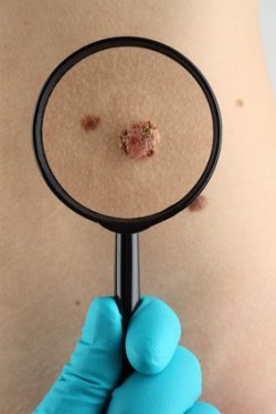 viagra-melanoma-mole