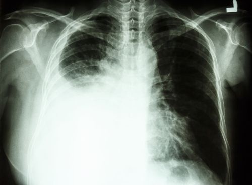  lung-cancer-congress