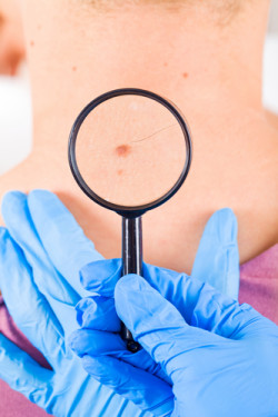 viagra melanoma skin cancer check