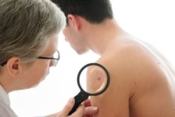viagra-melanoma-exam
