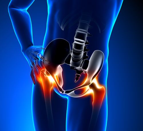hip pain hip class action hip implant lawsuit