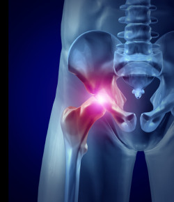 Hip pain as an inflamed joint with an x-ray medical illustration of a frontal close up macro of a human skeleton with a painful area in red as a chronic disease and injury to bone needing hip replacement surgery.