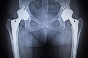 biomet-hip-replacement