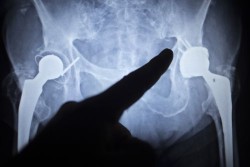 x-ray of Biomet hip implants that are part of the Biomet lawsuit