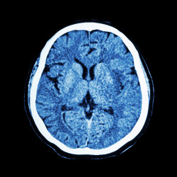brain scan dilantin cerebellar atrophy