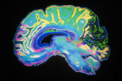 brain-scan-dilantin