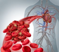 ivc-clot-illustration