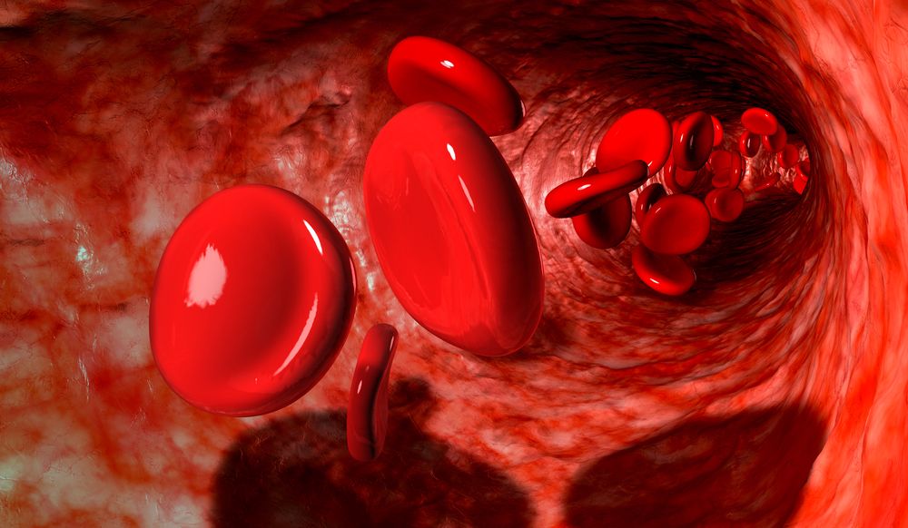 Eight Plaintiffs File Blood Clot Filter Side Effects Lawsuit
