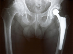Xray of Left Hip Replacement