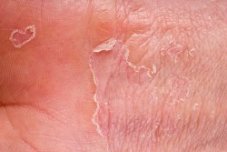 eczema closeup, rash