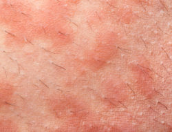 skin rash, dermatitis