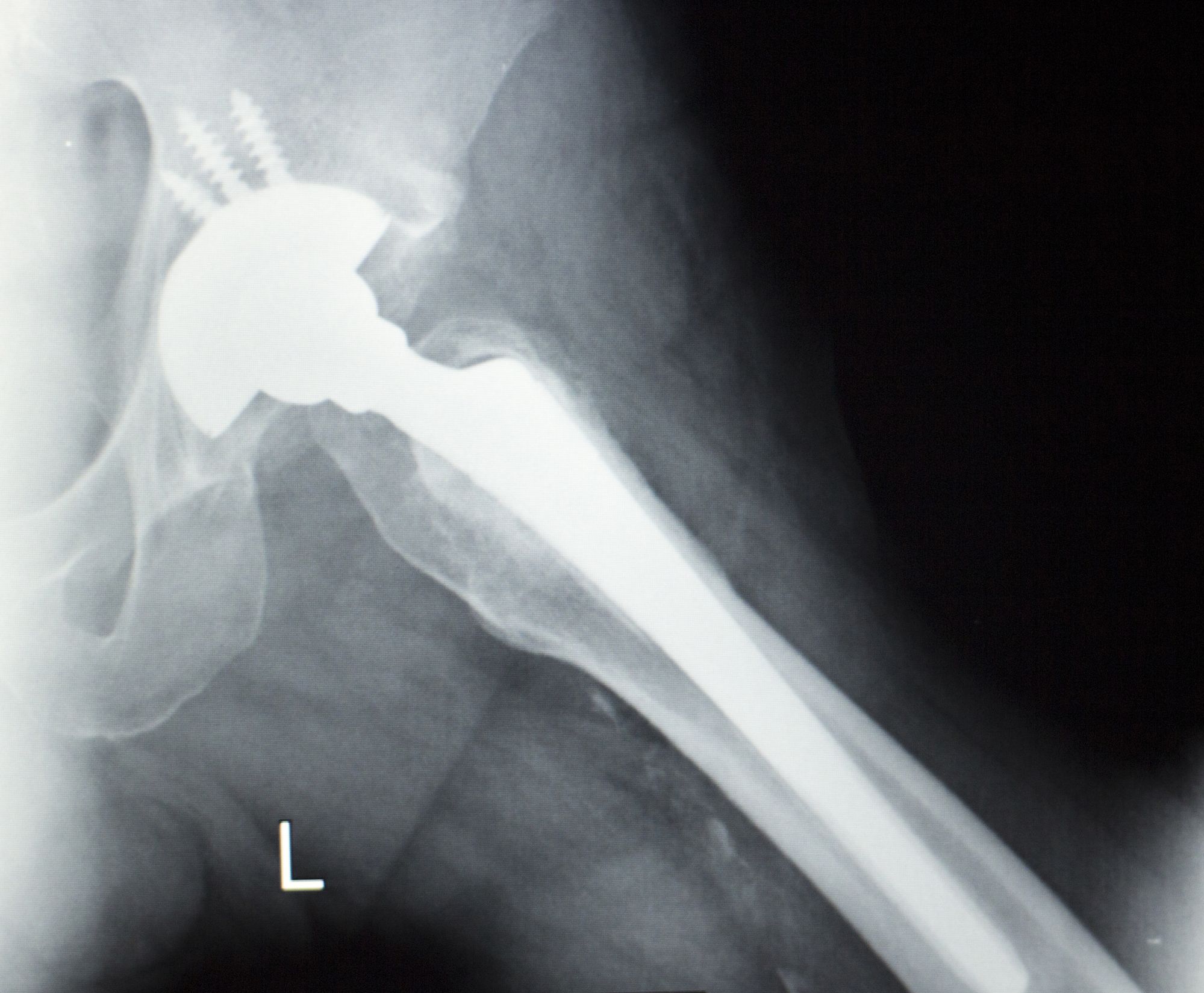 Reports of Trouble Lead to Stryker MetalonMetal Hip Implant Recall