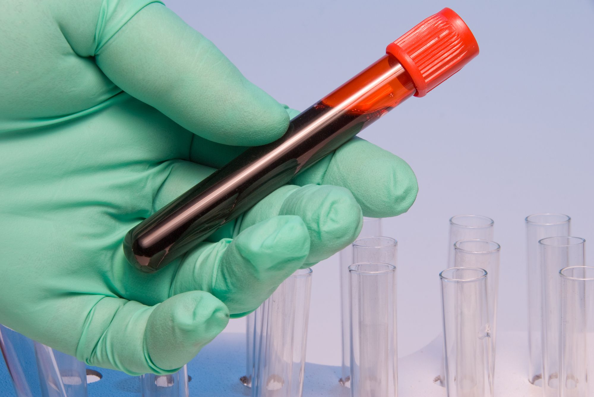 Blood Thinner Study Concludes Pradaxa Use Risky for Patients Top