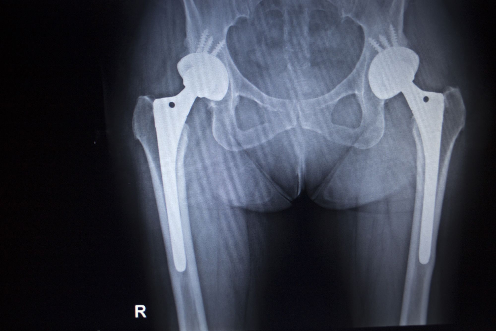 LFIT V40 Metal Hip Implant Complications Lead to Stryker Recall Top Class Actions