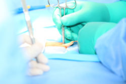 Open hernia surgery
