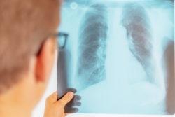 Doctor looks at x-ray image of lungs