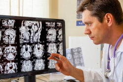 Dilantin cerebellar atrophy ataxia brain MRI
