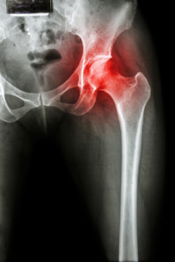 hip implant complications DePuy Zimmer Stryker xray