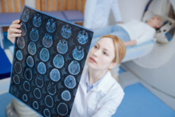 Dilantin cerebellar atrophy brain MRI