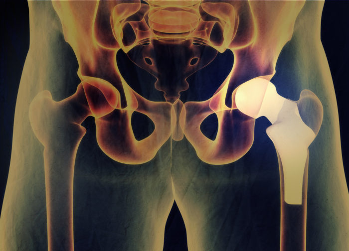 Biomet Hip Replacement Lawsuit Alleges Major Complications