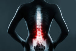 spinal fusion stimulator recall