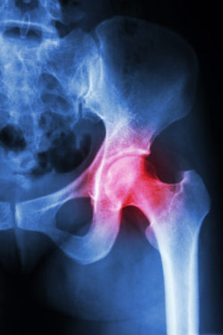 Stryker-Accolade-hip-implant-lawsuit