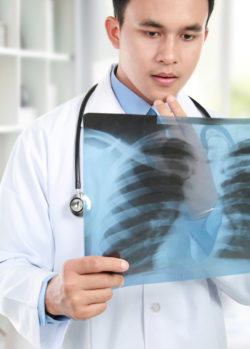 asbetos mesothelioma chest x-ray