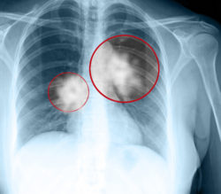 lung cancer, mesothelioma