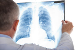 asbestos lung cancer doctor chest x-ray