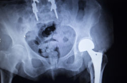 metal hip implant